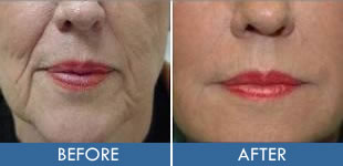 Facial liposculpture